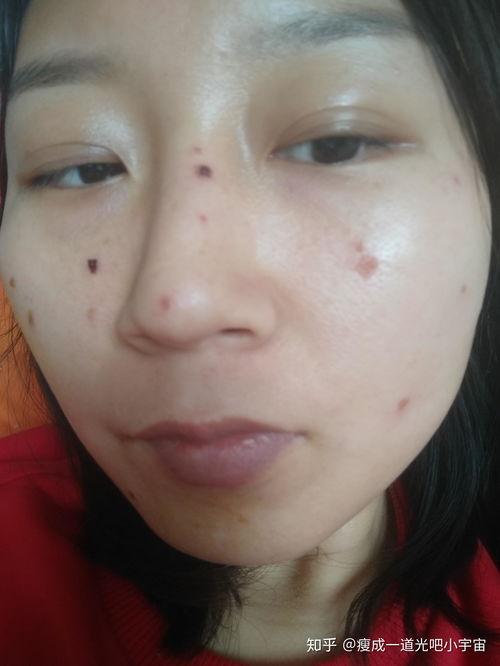 激光点痣视频,高效便捷的美容新选择