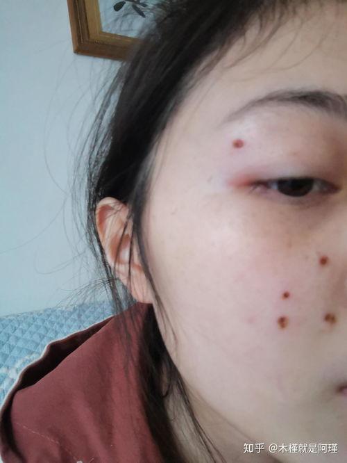 激光点痣视频,高效便捷的美容新选择