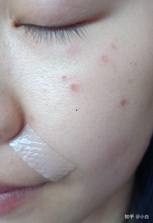 激光点痣视频,高效便捷的美容新选择